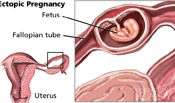 abortion