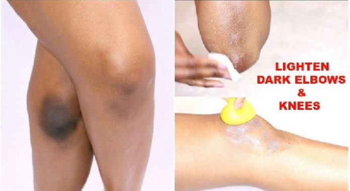 Lemon, baking soda, coconut oil can be used to lighten your dark elbows and knuckles