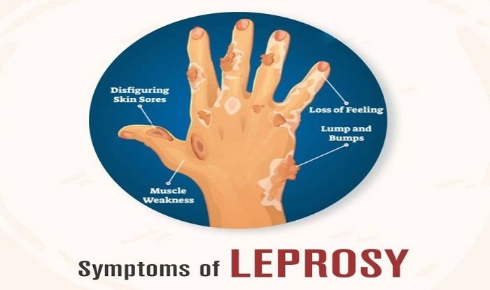 leprosy-symptoms-diagnosis-and-treatment