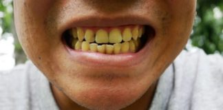 5 effective ways to get rid of yellow teeth