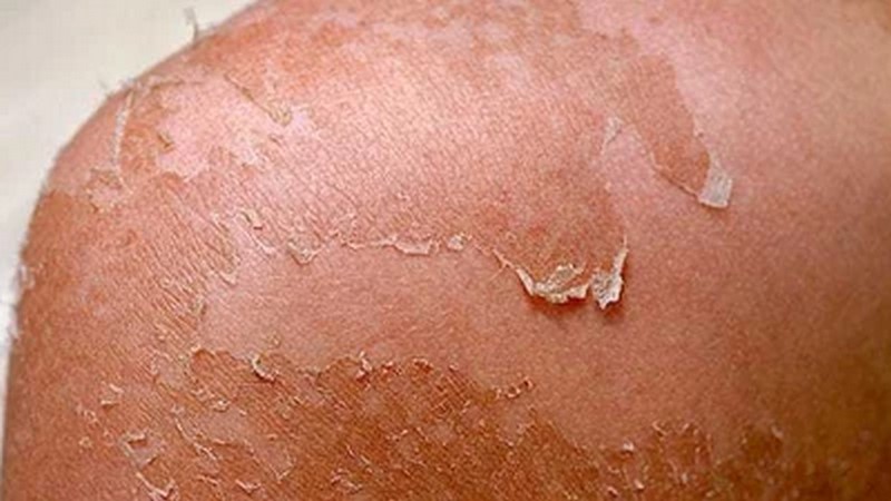 five-things-to-do-if-your-skin-is-peeling