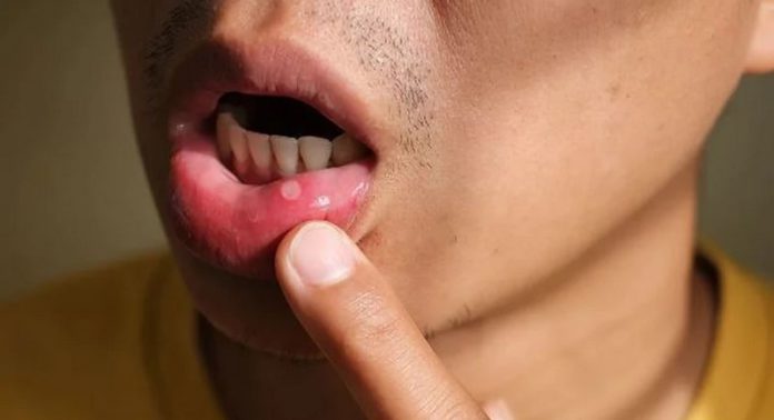 Mouth ulcer